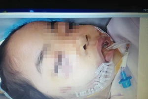 Lại một trẻ bị chó cắn nát mặt phải khâu hơn 200 mũi