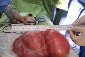 Cắt tử cung và buồng trứng lấy khối u hơn 4 kg 