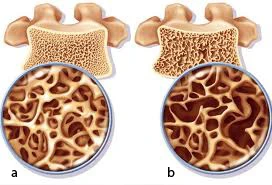 Phân biệt bệnh nhuyễn xương và loãng xương