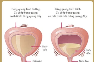 Đi tiểu nhiều, có phải bệnh lý?