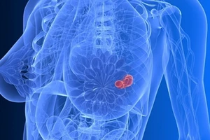 Ung thư vú đang gia tăng và trẻ hóa