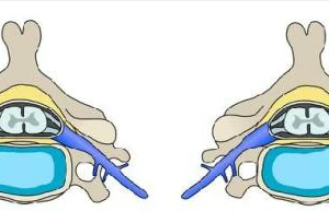 Dấu hiệu thoát vị đĩa đệm cột sống cổ