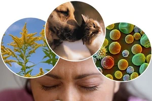 Biến chứng của bệnh viêm mũi dị ứng