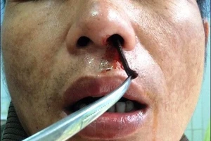 Uống nước suối bị đỉa chui vào lỗ mũi