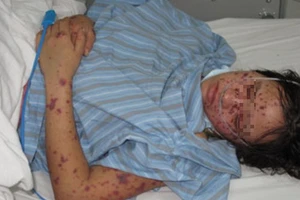 Bệnh nhân mắc viêm não mô cầu có thể tử vong sau 1 ngày