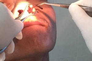 Gắp con đỉa dài 6 cm ra khỏi mũi