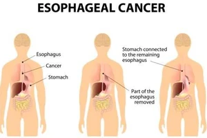 Bệnh nướu răng có thể dẫn đến ung thư thực quản