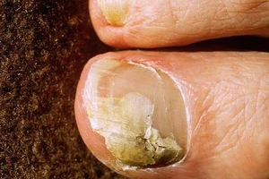 6 mẹo dễ dàng giúp trị bệnh nấm móng