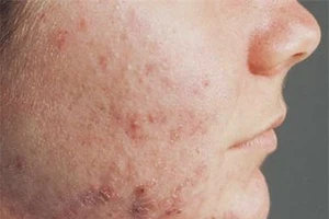 Cách xử lý khi bị viêm da cơ địa