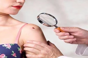 5 nguy cơ không ngờ gây ung thư da