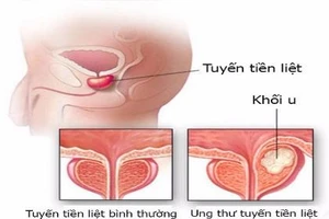 10 căn bệnh ung thư có nguy cơ cao với nam giới