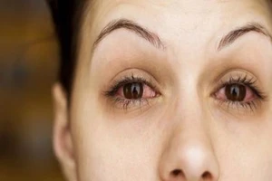 15 nguyên nhân khiến mắt bạn thường xuyên bị đỏ