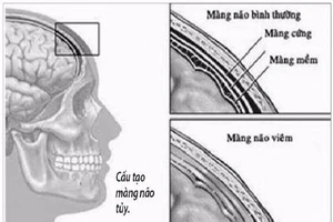 Lao màng não, thể lao nguy hiểm