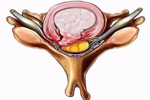 Thoát vị đĩa đệm và những hậu quả khó lường