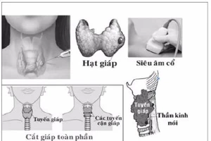 Ai dễ bị ung thư tuyến giáp?