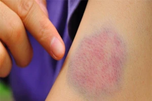 Vì sao vết thương gây bầm tím kéo dài?