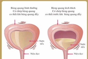 Đi tiểu nhiều - bệnh gì?
