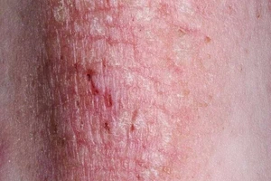 6 nguyên nhân làm bệnh eczema nặng thêm