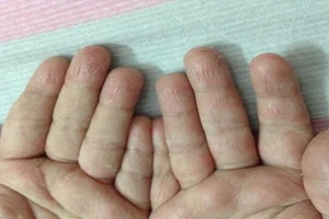 Tróc da bàn tay, bệnh gì?