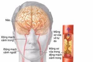 Dấu hiệu sớm thiếu máu não