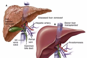 Khi vàng mắt vàng da,ung thư gan đã ở giai đoạn muộn