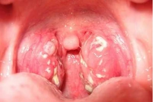 Viêm họng hạt nguy hiểm như thế nào?