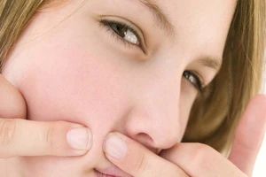 Cách trị mụn 'một đi không trở lại' cực kỳ hiệu quả