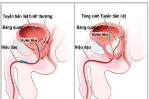 Nguyên nhân và cách phòng tránh phì đại tiền liệt tuyến