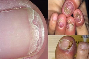 Cần kiên trì khi trị nấm móng