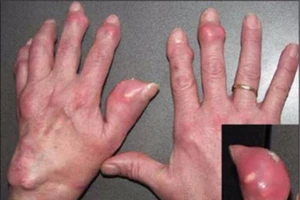 Thuốc nào tăng nguy cơ mắc bệnh gút?