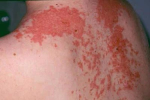 Giời leo, tại sao không được dùng kháng sinh?