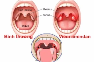 Viêm amidan, khi nào nên cắt?