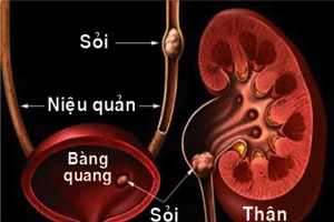 Sỏi thận hình thành trong cơ thể bạn như thế nào