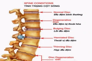 Quá trình bạn bị thoát vị đĩa đệm diễn ra như thế nào