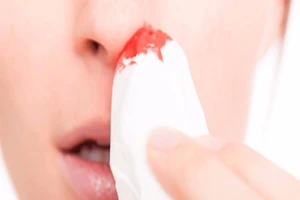 Mẹo nhỏ giúp máu cam ngừng chảy hiệu quả