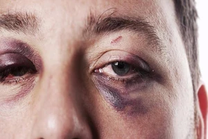 3 mẹo nhỏ xóa quầng thâm 'mắt gấu trúc'