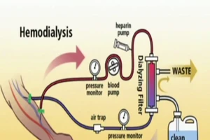 Nước chạy thận không tinh khiết sẽ nguy hiểm thế nào?