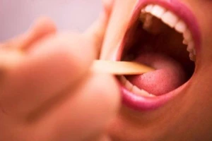 Bạn cần cắt bỏ amidan ngay khi thấy 5 dấu hiệu này