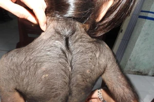 Kỳ lạ bé gái 5 tuổi mọc lông đầy mình như người sói