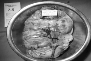 Thiếu nữ suy kiệt vì phải 'đeo' khối u buồng trứng 16kg