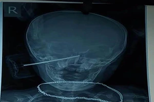 Bé 11 tháng tuổi bị thanh sắt đâm xuyên má