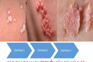 Tại sao trẻ em lại mắc sùi mào gà?