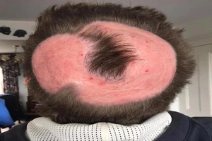 Trọc đầu vĩnh viễn vì thuốc nhuộm tóc giá rẻ