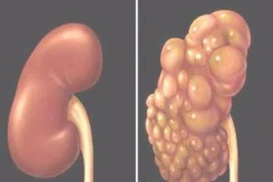 Bệnh thận đa nang và các biến chứng