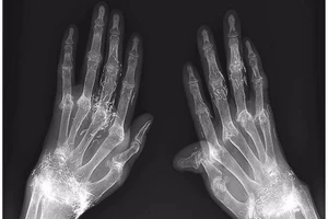 Dùng vàng khâu khớp tay để trị thấp khớp