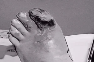 Ngón chân ‘nổ tung’ sau khi đá phải cạnh bàn 