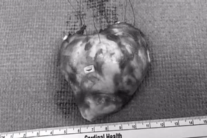 Phẫu thuật cắt khối u tim lớn nhất thế giới