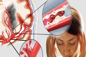 Tại sao trời lạnh dễ bị đột quỵ?