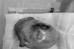 Tinh hoàn 'đi lạc' suốt 50 năm, to như trứng đà điểu