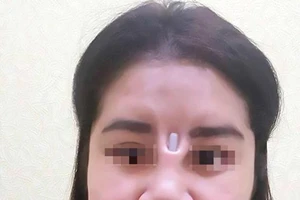 Bị thanh silicon đâm thủng mũi chòi ra giữa mặt